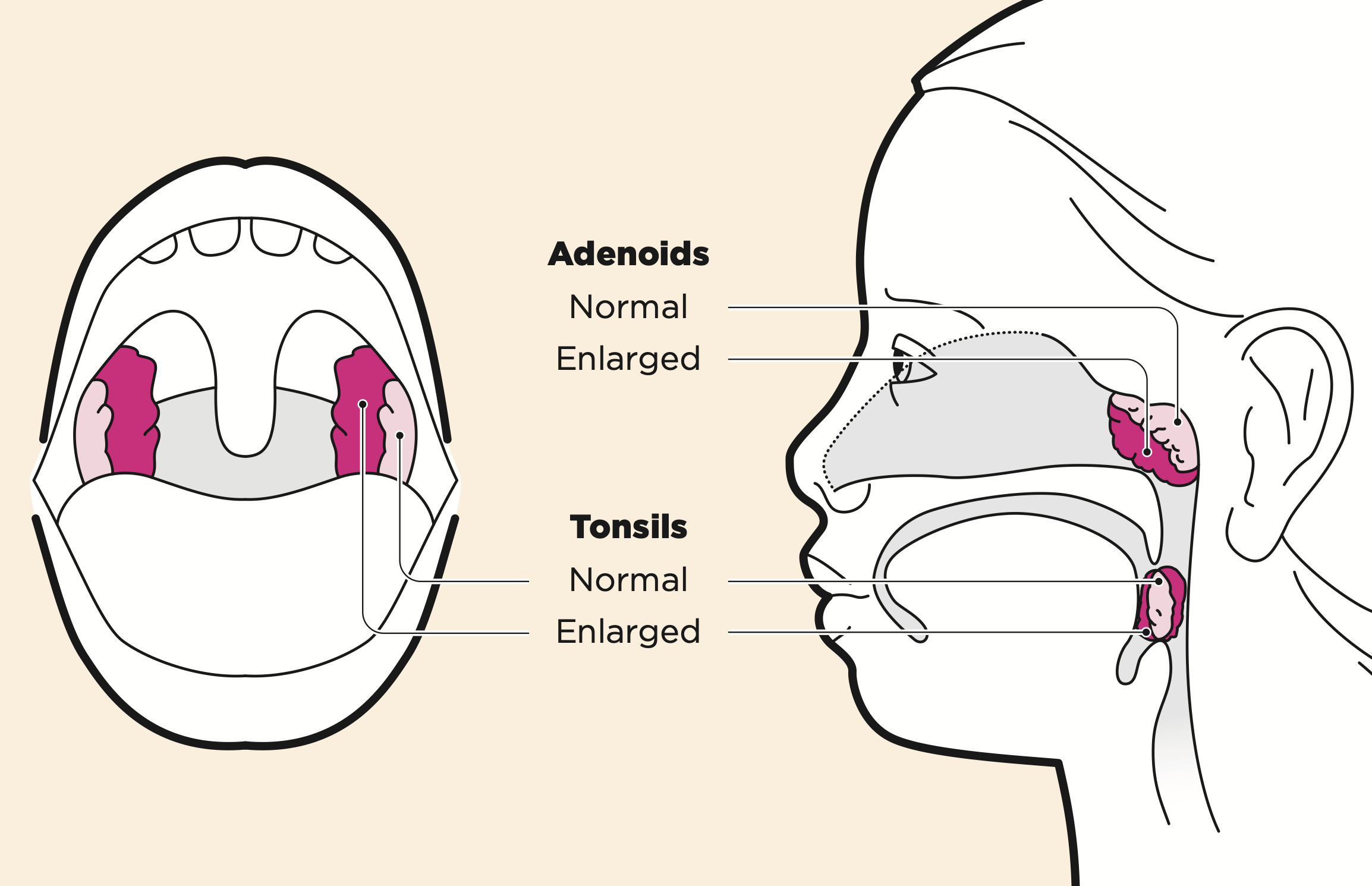 Anatomy Of Tonsils And Adenoids Anatomical Charts And Posters | Images ...