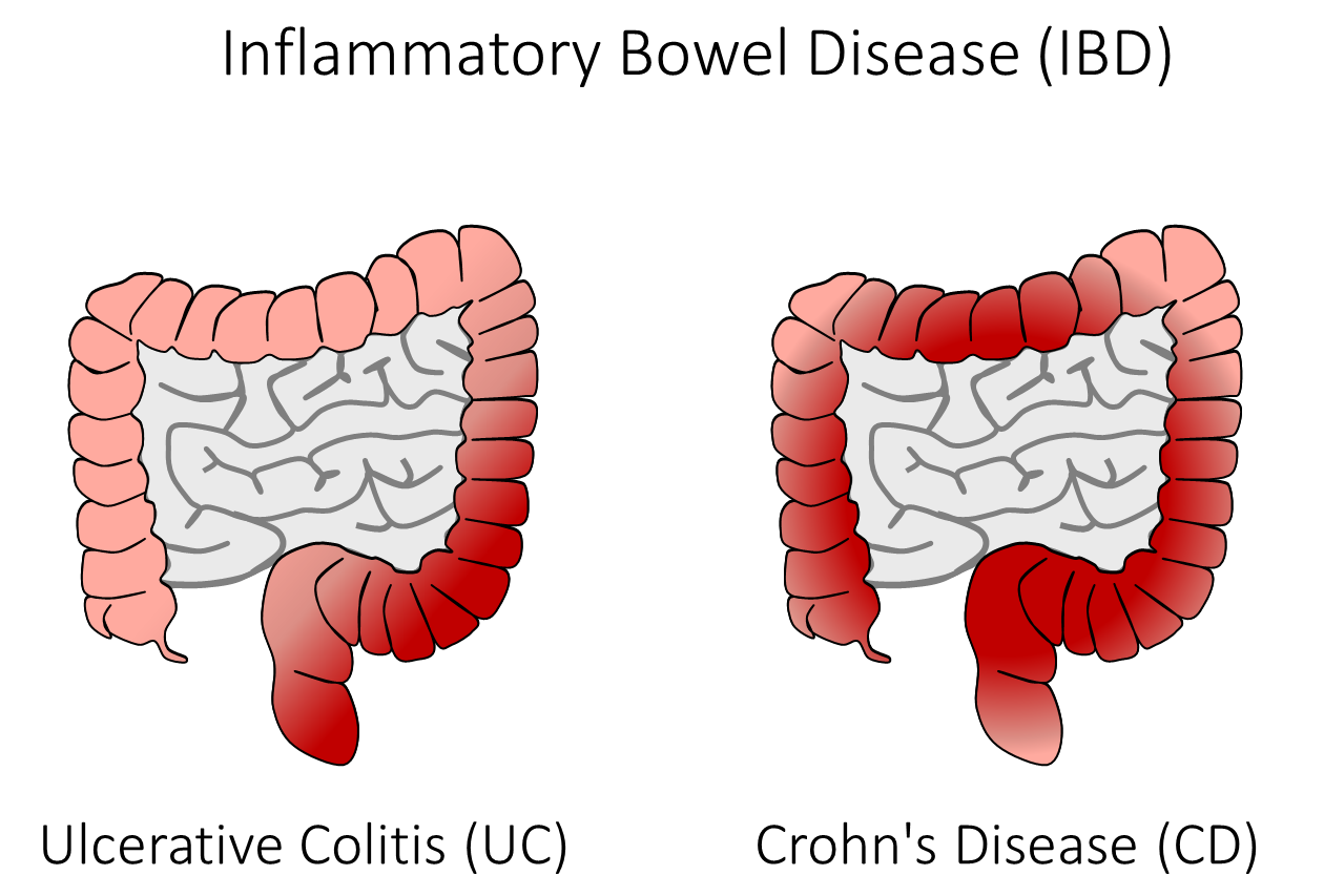 Crohn s Colitis Upopolis
